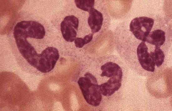 Leukocytose i blodet: et tegn på sykdom?