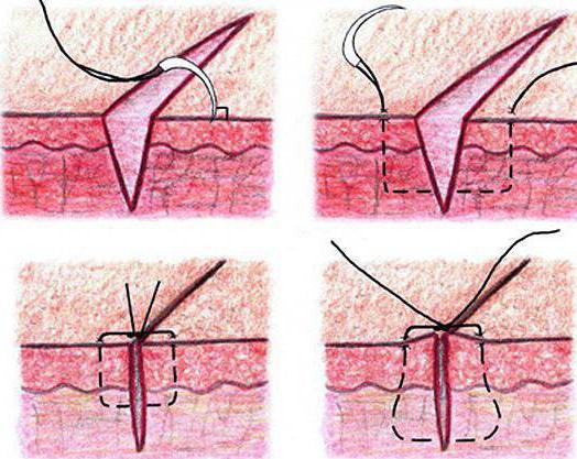 Selvopptakende suturer helbrede